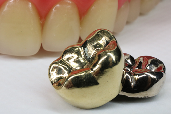 銀歯　金パラ　歯科用　銀合金　金　銀　スクラップ　除去冠　歯医者　金属